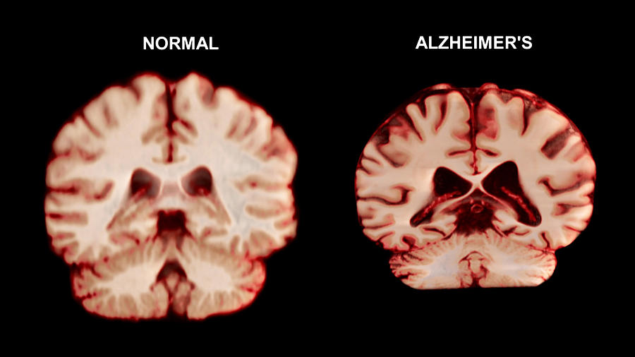 Neurologists Reveal: The Surprising Gesture When Parking That Could Signal Cognitive Decline 3 Normal Brain vs. Alzheimer's Brain