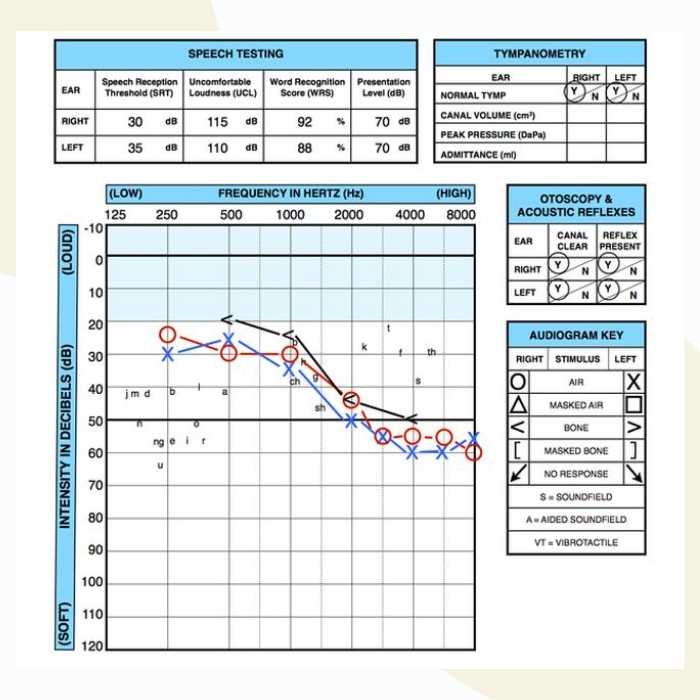 Denied VA Hearing Loss Claim? Here’s How to Fight Back and Win Benefits 2 Standard audiogram chart